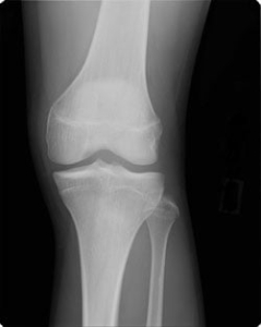 膝の軟骨